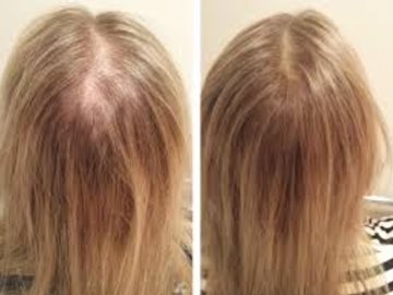 Are You Experiencing Thinning Hair